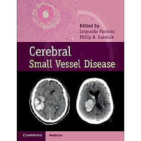 Cerebral Small Vessel Disease,Leonardo Pantoni,Cambridge University Press,9781107031661, Cerebral Small Vessel Disease,Leonardo Pantoni,Cambridge University Press,9781107031661,