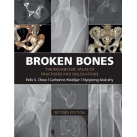 Broken Bones 2nd Edition,Felix S. Chew,Cambridge University Press,9781107499232,