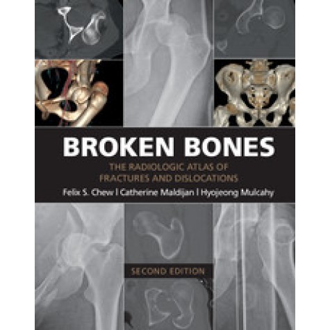 Broken Bones 2nd Edition,Felix S. Chew,Cambridge University Press,9781107499232,